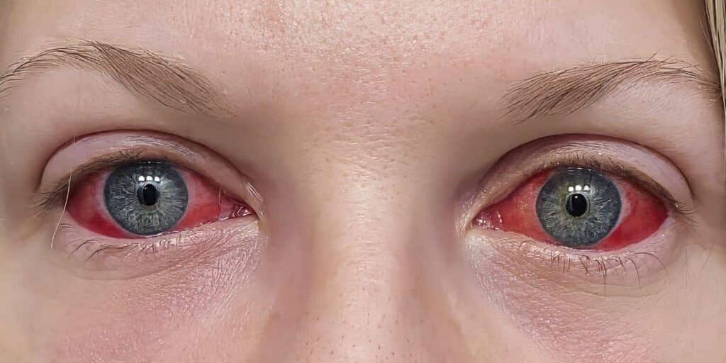 symptoms of cocaine eyes